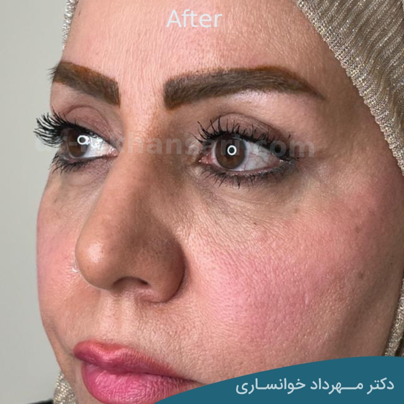 عمل زیبایی پلک افتاده - دکتر خوانساری