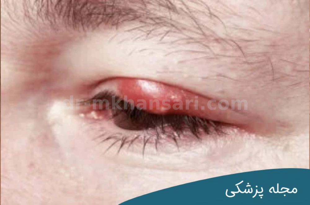 کیست چشم - دکتر خوانساری