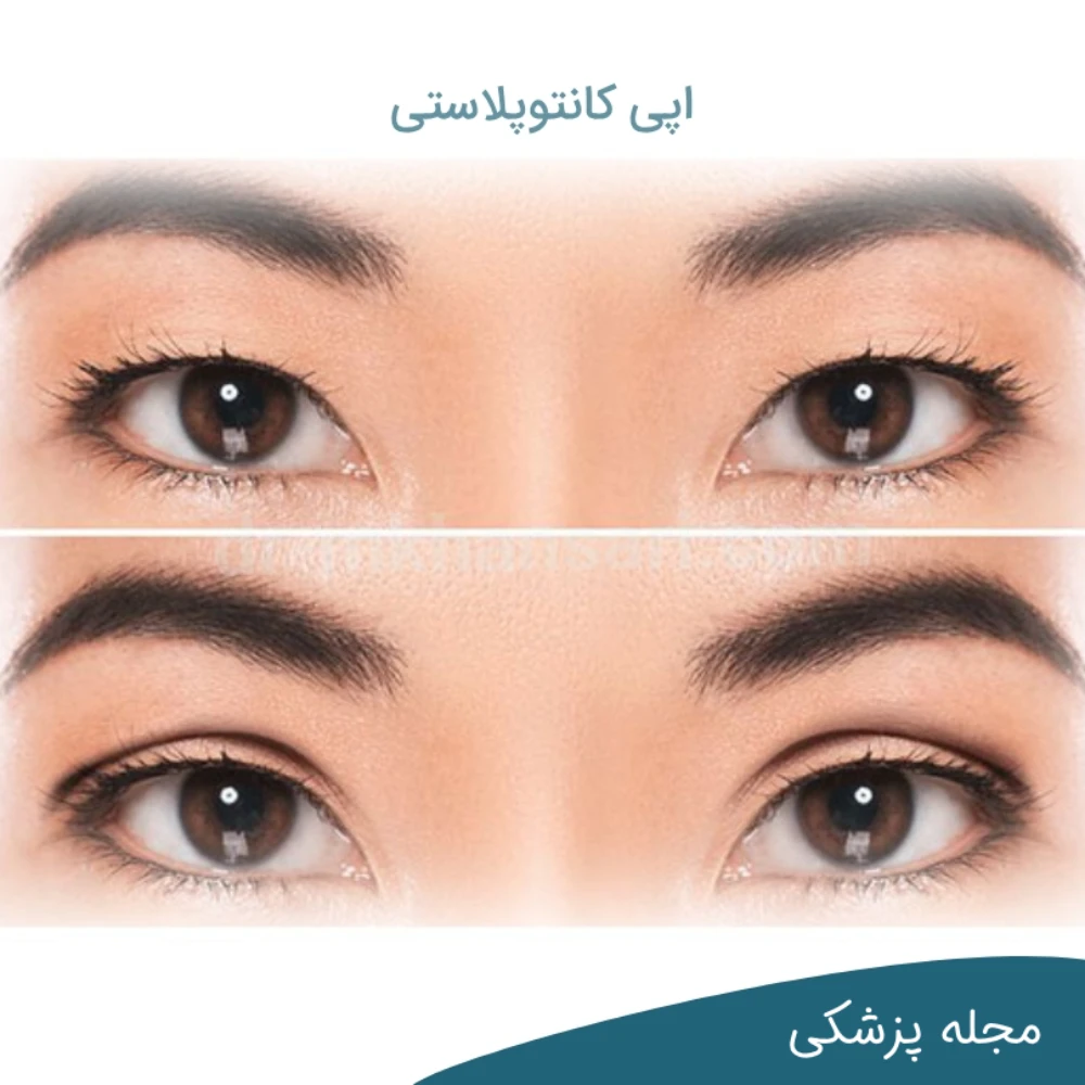 عمل جراحي بزرگ كردن چشم - دکتر مهرداد خوانساری