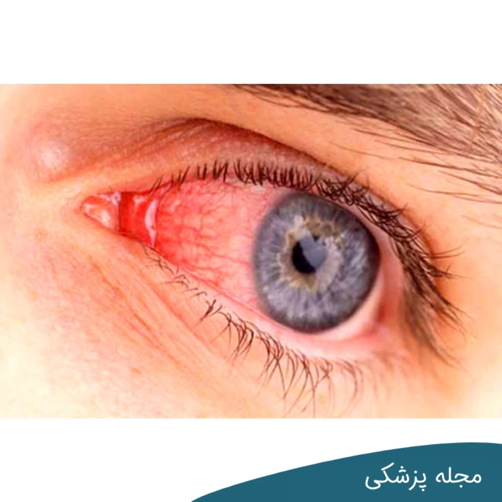 روماتیسم چشمی - dr-mkhansari