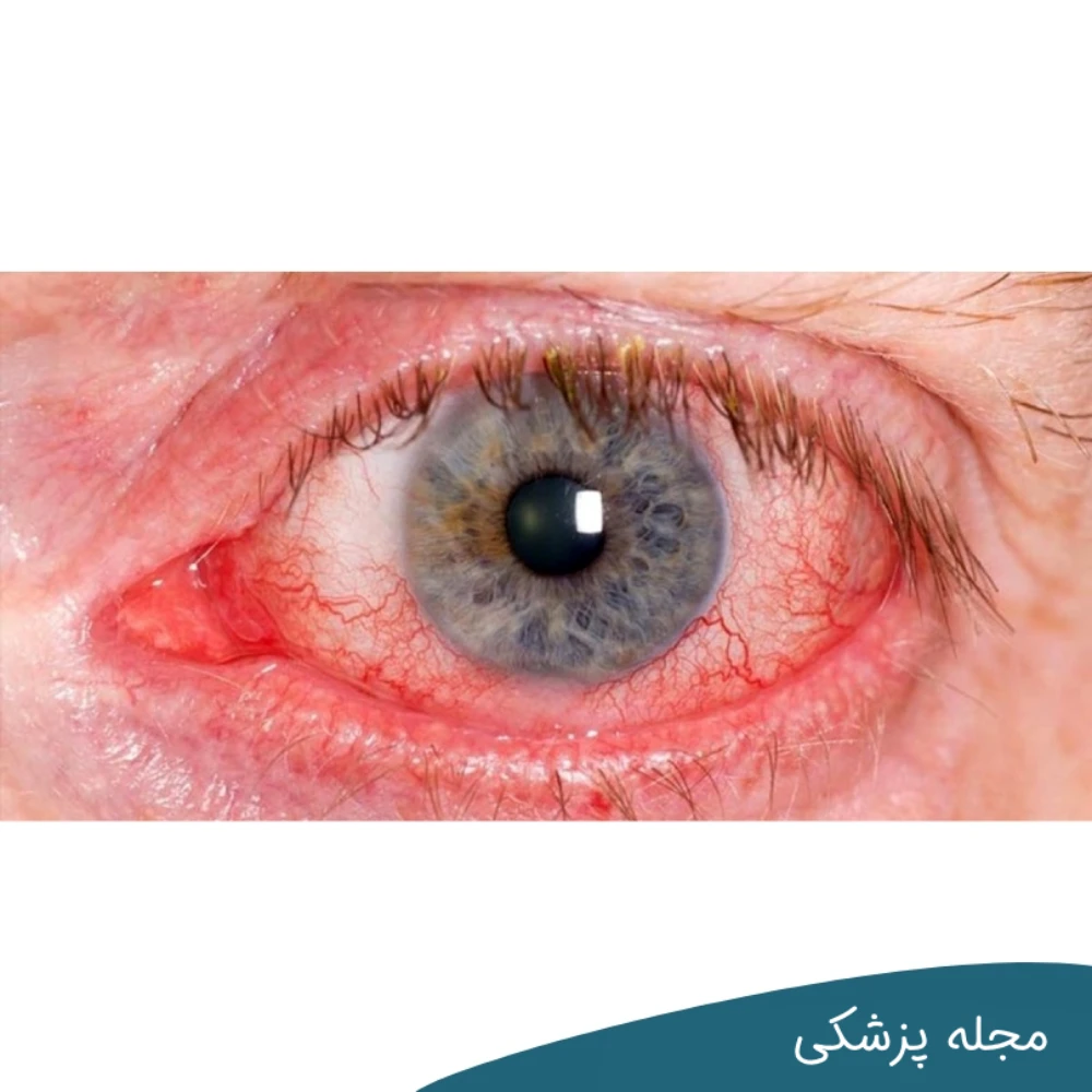 روماتیسم چشمی - dr-mkhansari
