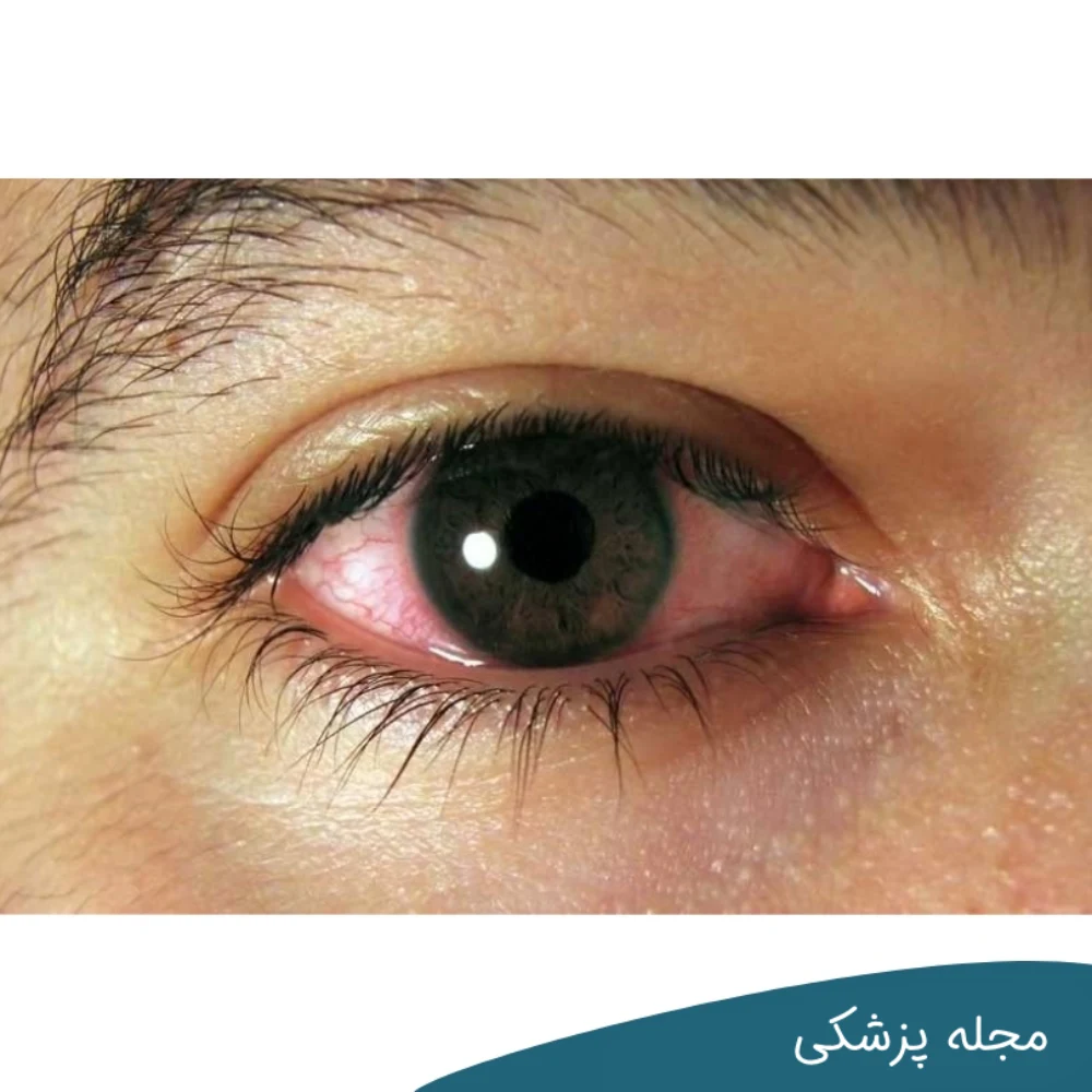 روماتیسم چشمی - dr-mkhansari