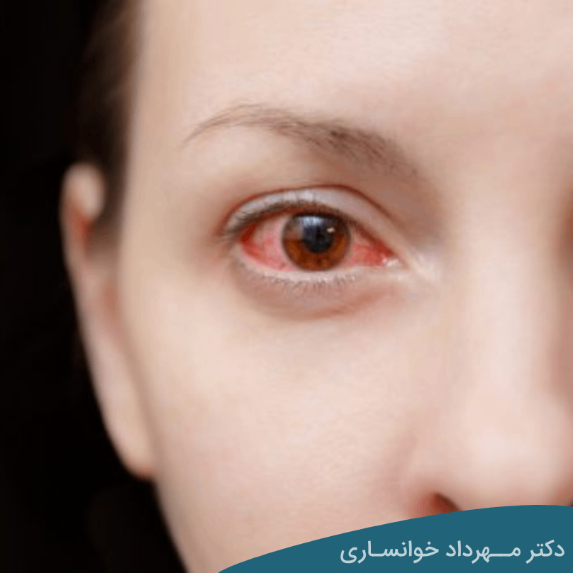 بیماری بهجت چشم - دکتر خوانساری