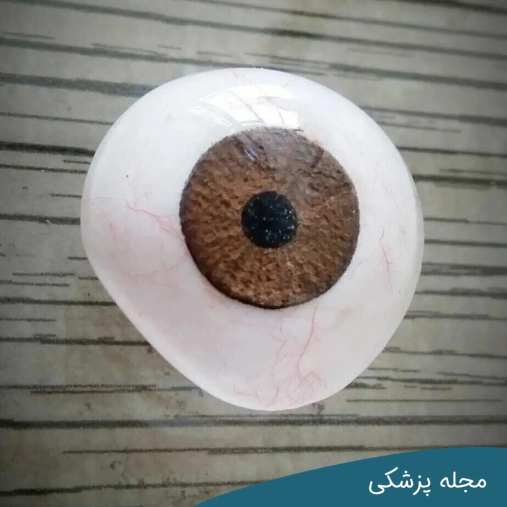 نحوه مراقبت از چشم مصنوعی - دکتر مهرداد خوانساری