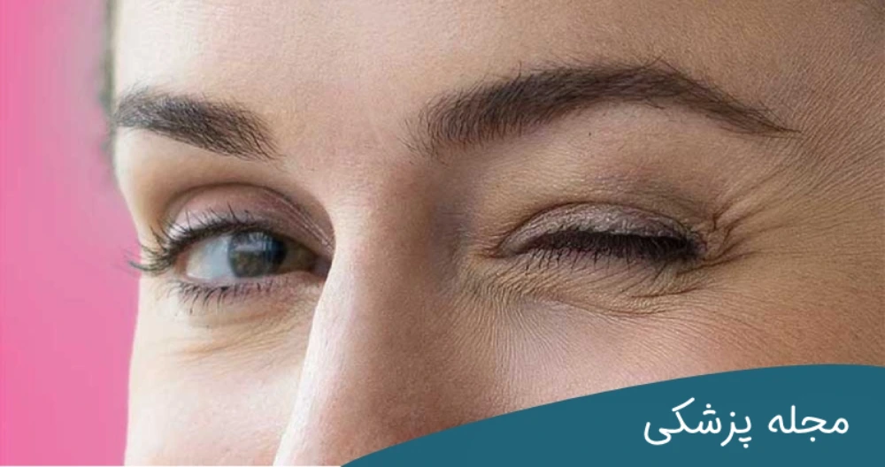 پرش پلک - دکتر مهرداد خوانساری