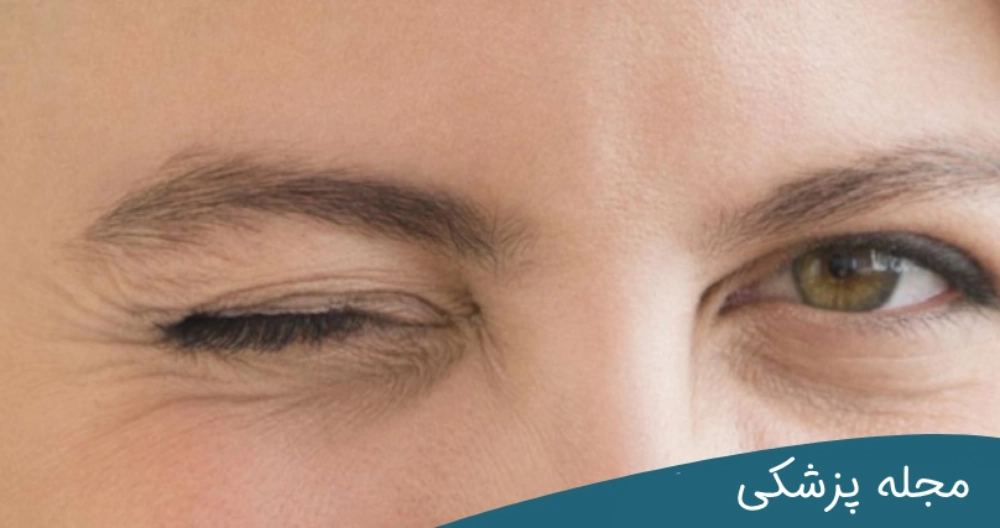 پرش پلک - دکتر مهرداد خوانساری
