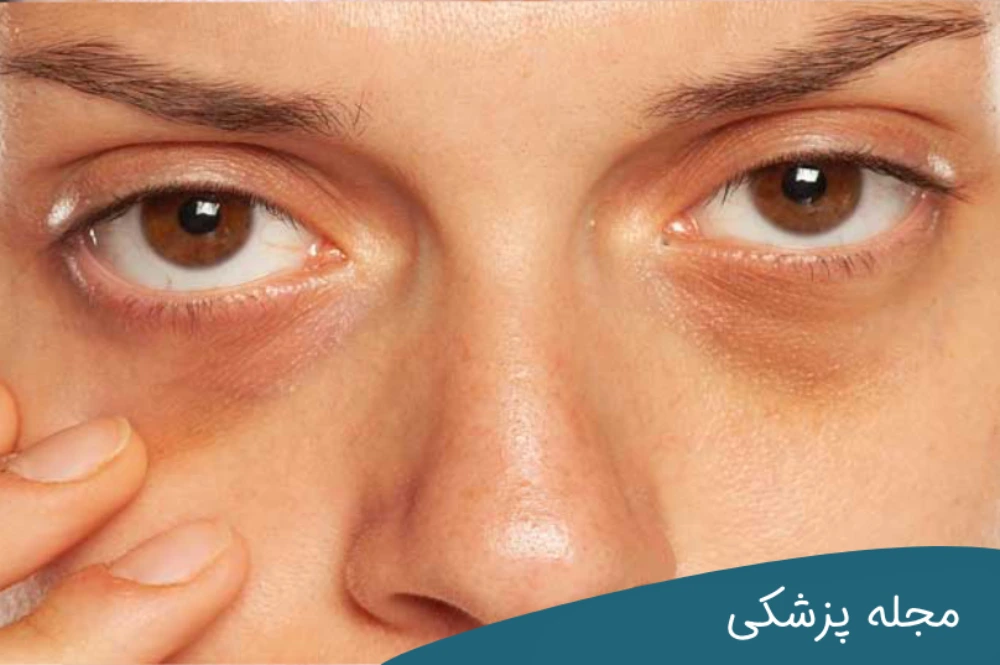 رابطه پف زیر چشم و کبد - دکتر مهرداد خوانساری