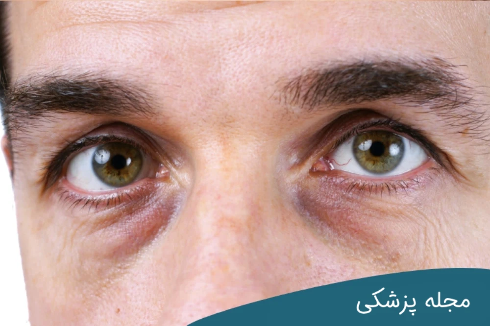 رابطه پف زیر چشم و کبد - دکتر مهرداد خوانساری