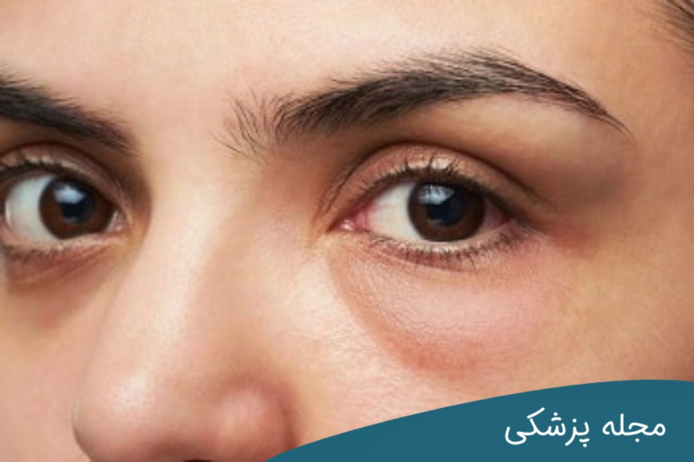 رابطه پف زیر چشم و کبد - دکتر مهرداد خوانساری