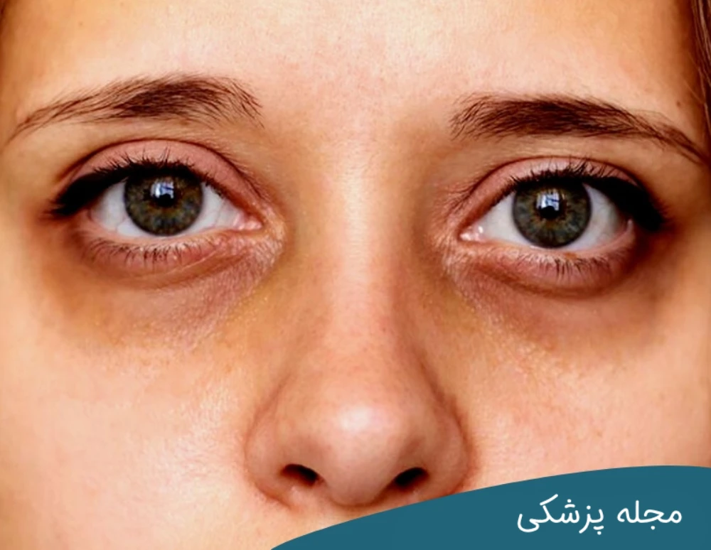 رابطه پف زیر چشم و کبد - دکتر مهرداد خوانساری