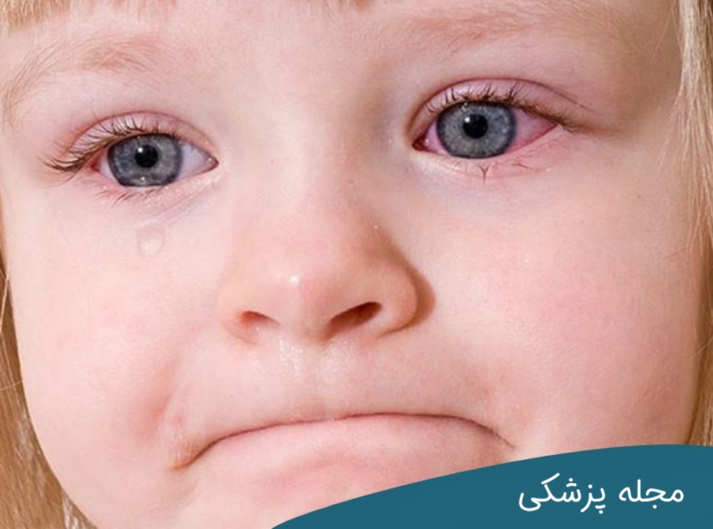 علت التهاب چشم در کودکان - دکتر خوانساری