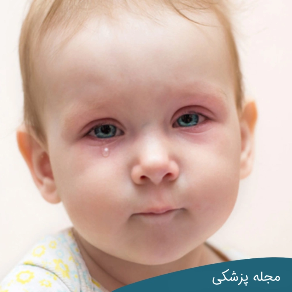 علت التهاب چشم در کودکان - دکتر خوانساری