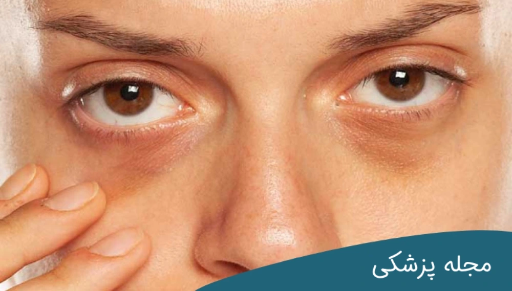 خمیر دندان برای پف زیر چشم - دکتر مهرداد خوانساری