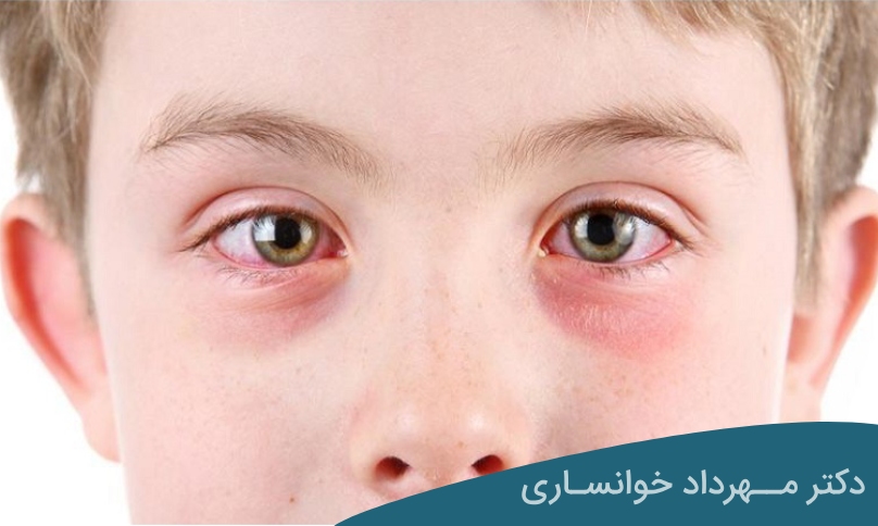 علت التهاب چشم در کودکان - دکتر خوانساری