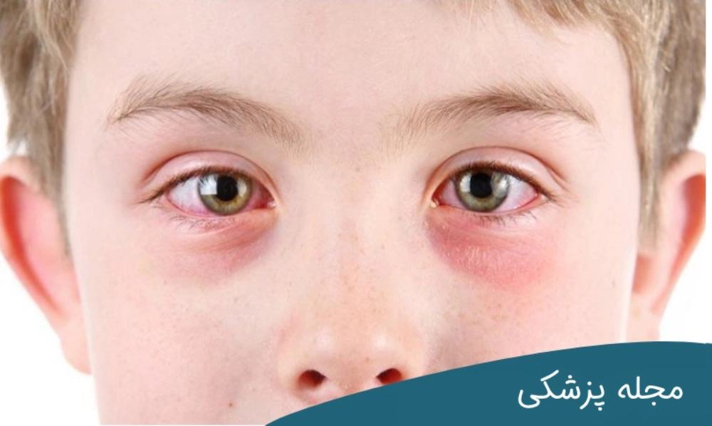 علت التهاب چشم در کودکان - دکتر خوانساری