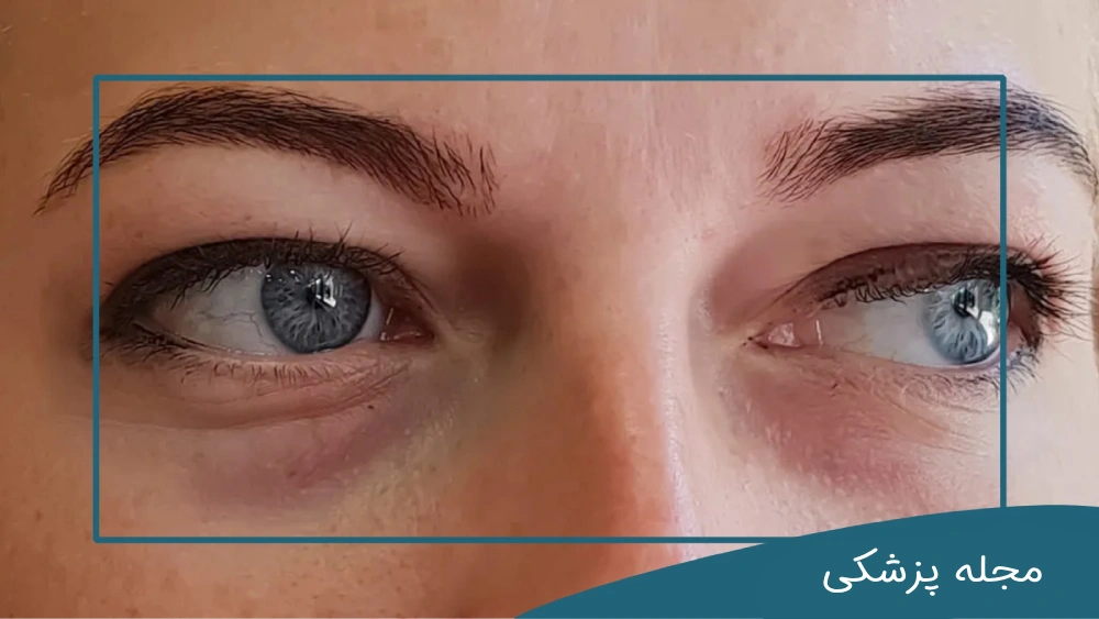 رابطه پف زیر چشم و کبد - دکتر مهرداد خوانساری