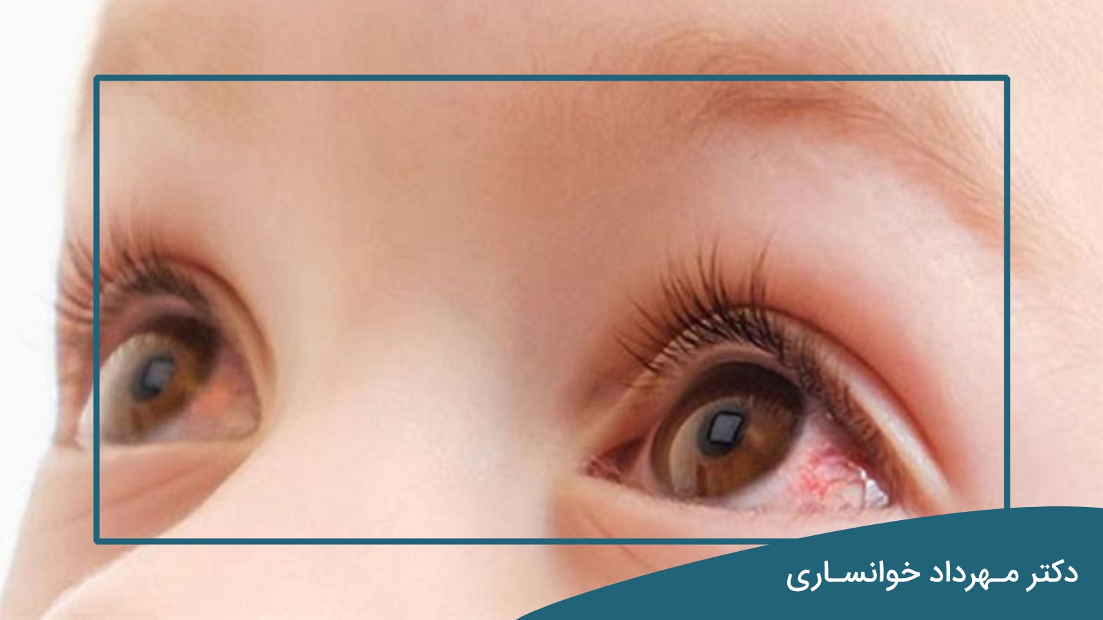 علت التهاب چشم در کودکان - دکتر خوانساری