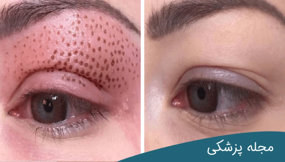 بلفاروپلاستی با لیزر-دکتر خوانساری