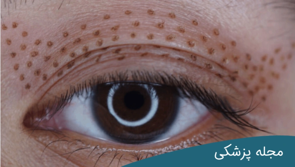 بلفاروپلاستی با لیزر-دکتر خوانساری