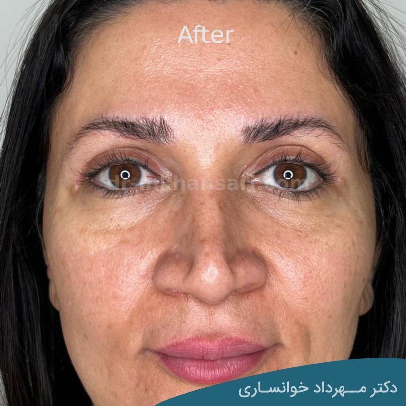 مراقبت های بعد از عمل بلفاروپلاستی- dr-mkhansari.com