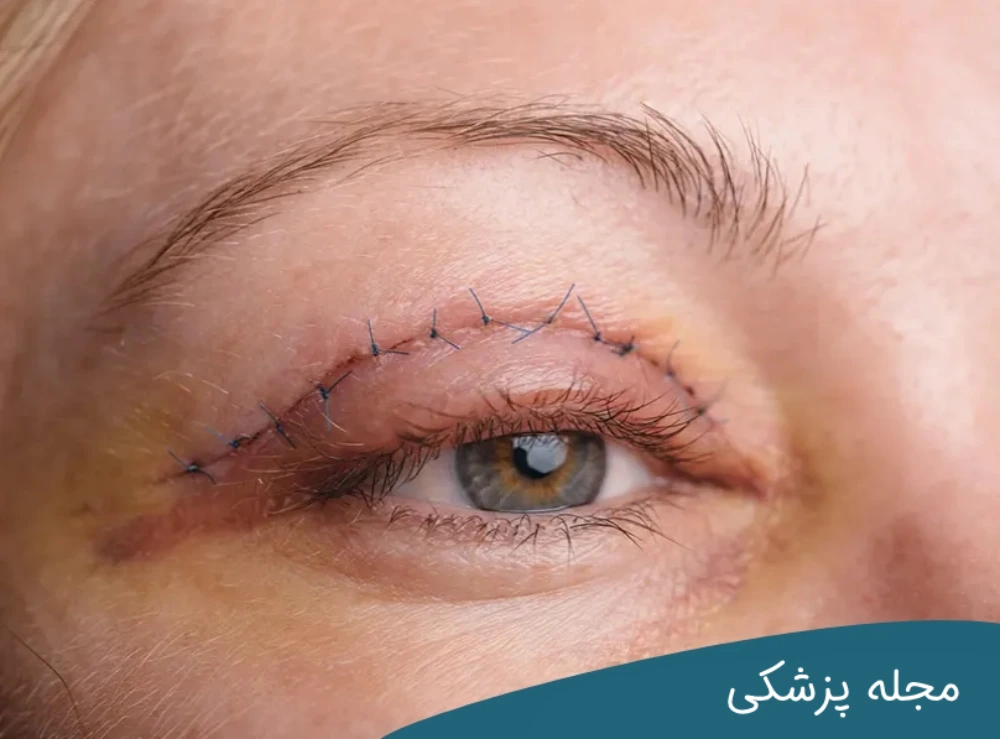 گوشت اضافه بعد از بلفاروپلاستی-دکتر خوانساری