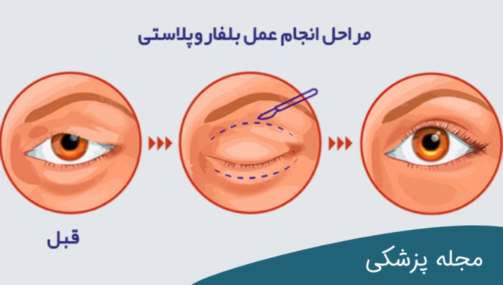 مراحل بهبود بلفاروپلاستی-دکتر خوانساری