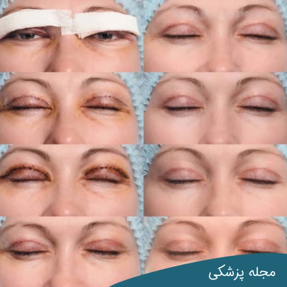مراحل بهبود بلفاروپلاستی-دکتر خوانساری
