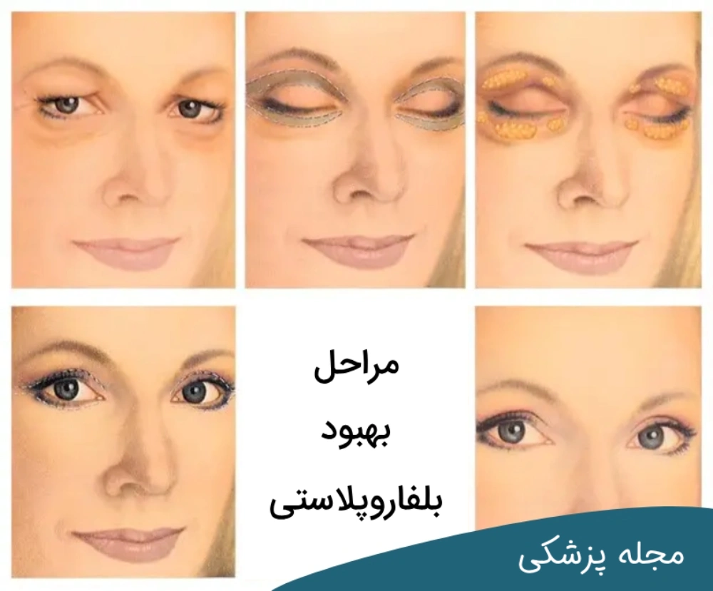 مراحل بهبود بلفاروپلاستی-دکتر خوانساری