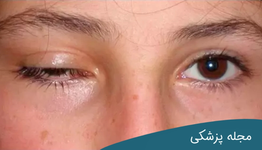 قرینه نبودن چشم بعد از عمل پلک-دکتر خوانساری