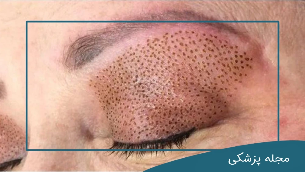 بلفاروپلاستی با لیزر-دکتر خوانساری