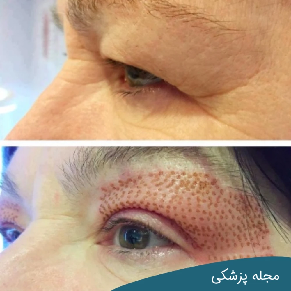 روش جایگزین بلفاروپلاستی-دکتر خوانساری