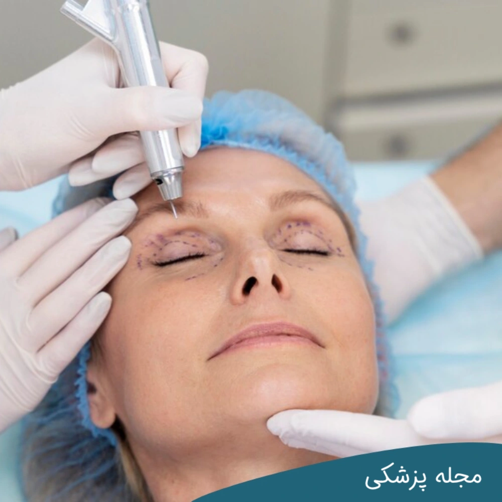 ترمیم عمل بلفاروپلاستی با دکتر خوانساری