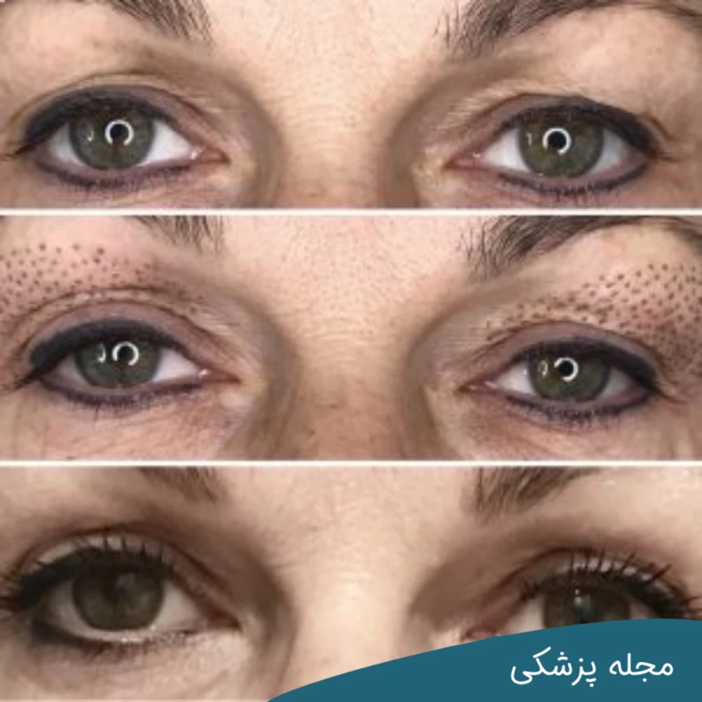 روش جایگزین بلفاروپلاستی-دکتر خوانساری