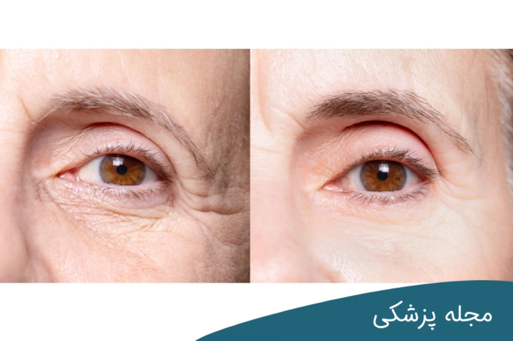 لیزر برای چروک دور چشم خوب است؟ دکتر خوانساری