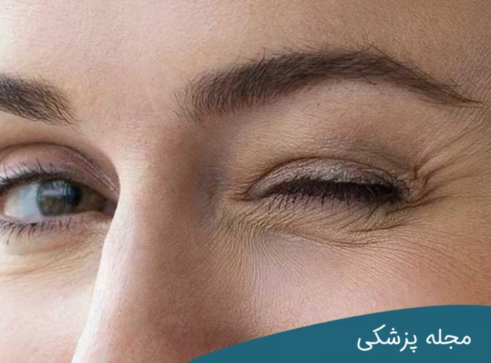 علت لرزش پلک - دکتر خوانساری