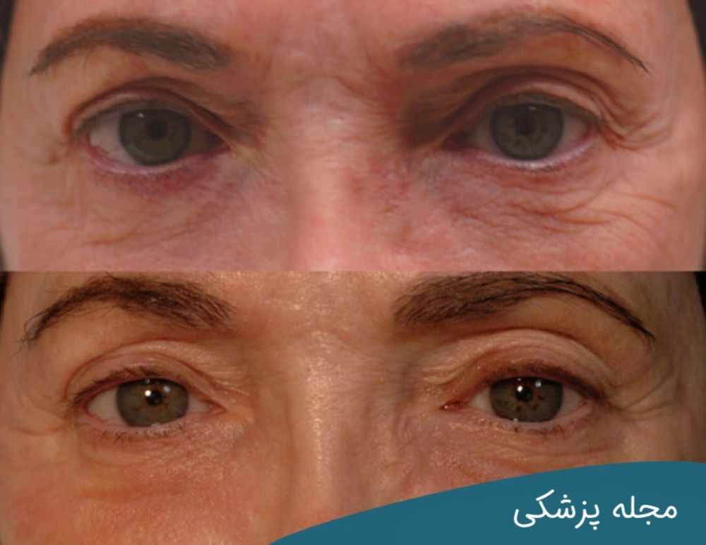 لیزر برای چروک دور چشم خوب است؟ دکتر خوانساری