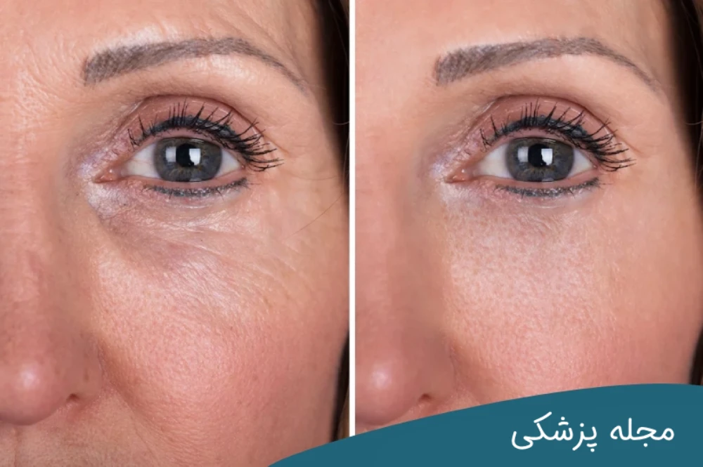 لیزر برای چروک دور چشم خوب است؟ دکتر خوانساری