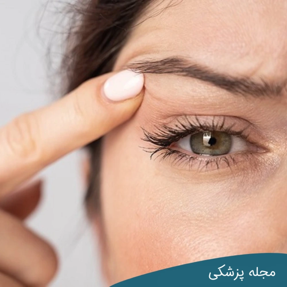 لرزش پلک چیست؟ دکتر خوانساری
