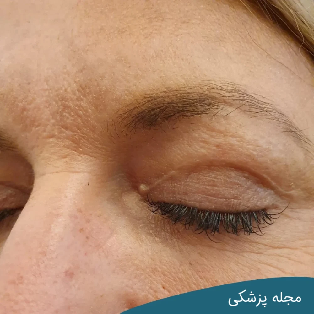 روش های از بین بردن جای بخیه بعد از عمل بلفاروپلاستی با دکتر خوانساری