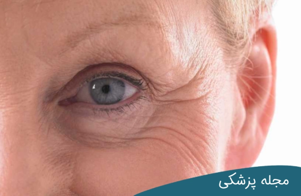 عمل بلفاروپلاستی برای چه سنی مناسب است؟ مجله پزشکی خوانساری
