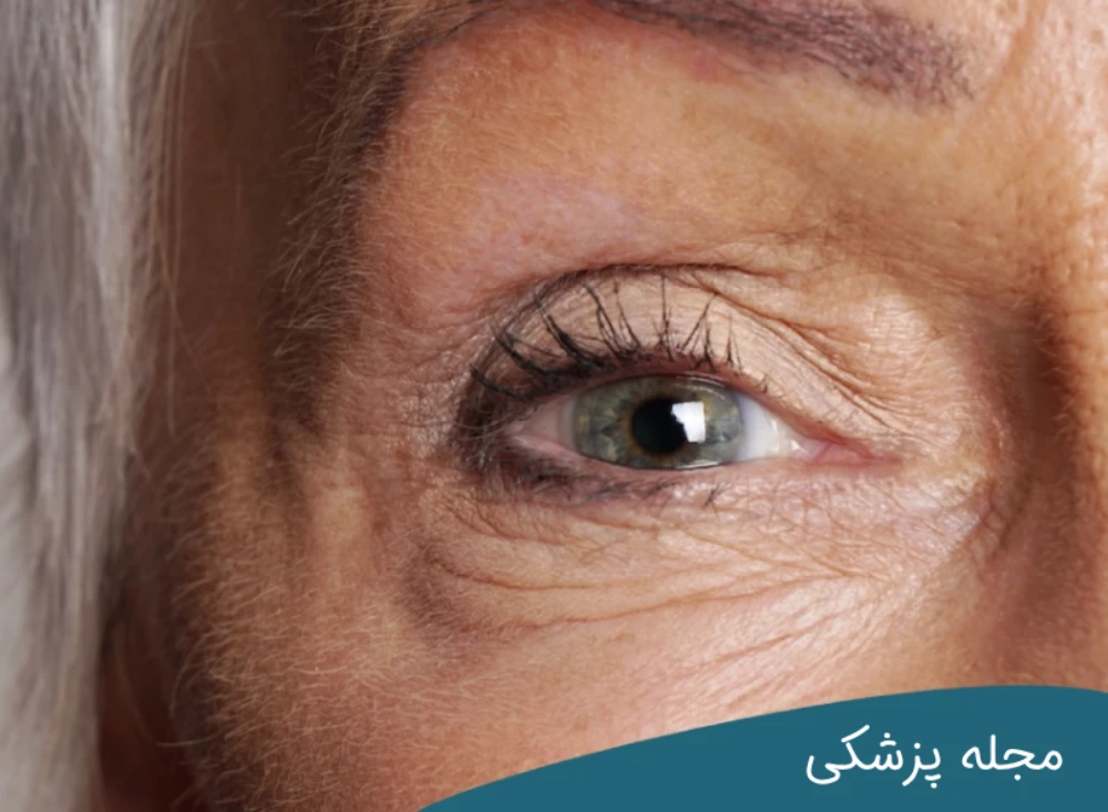 عمل بلفاروپلاستی در سنین بالا خطرناک است؟ مجله پزشکی خوانساری