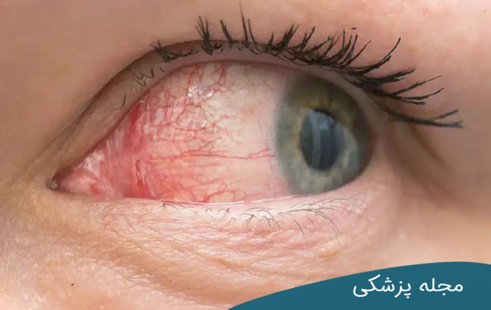 خشکی چشم چگونه است؟ مجله چشم پزشکی خوانساری