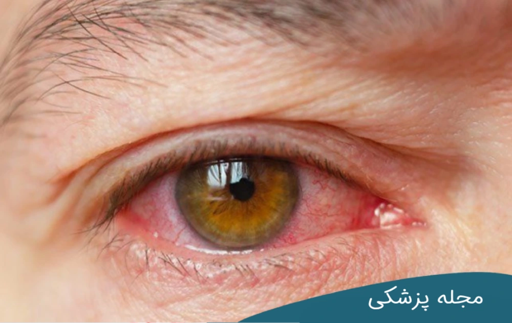 خشکی چشم