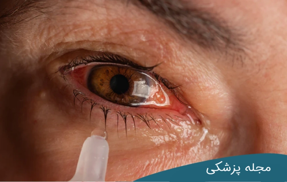 خشکی چشم