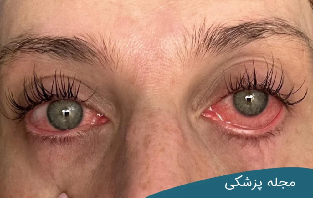 آیا خشکی چشم درمان قطعی دارد؟ مجله چشم پزشکی خوانساری