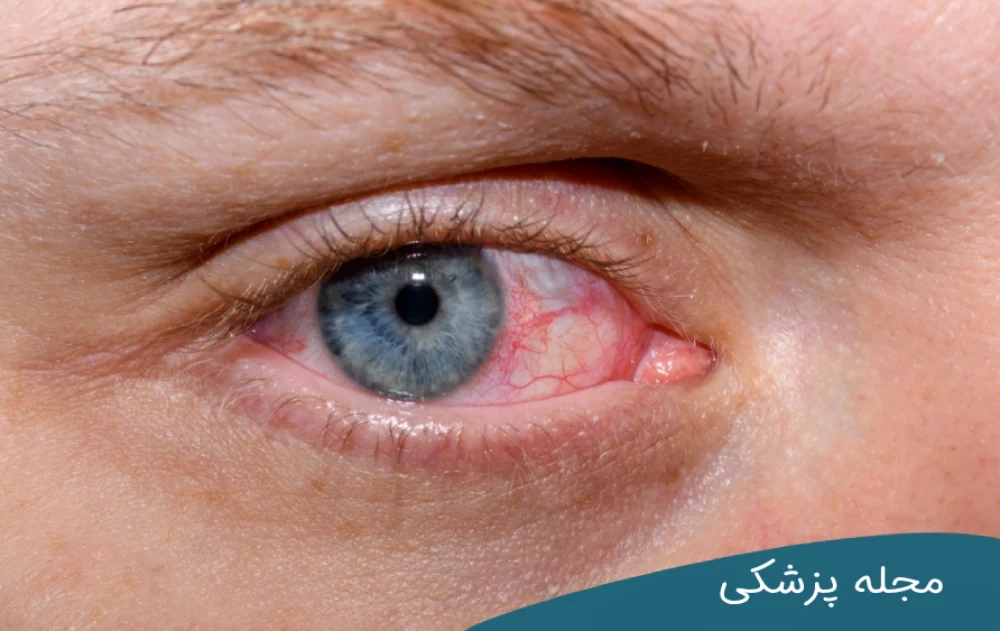 آیا خشکی چشم خطرناک است؟ مجله چشم پزشکی خوانساری