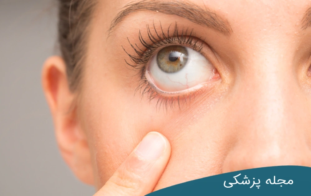 آیا خشکی چشم باعث ضعیف شدن چشم می شود؟ مجله چشم پزشکی خوانساری
