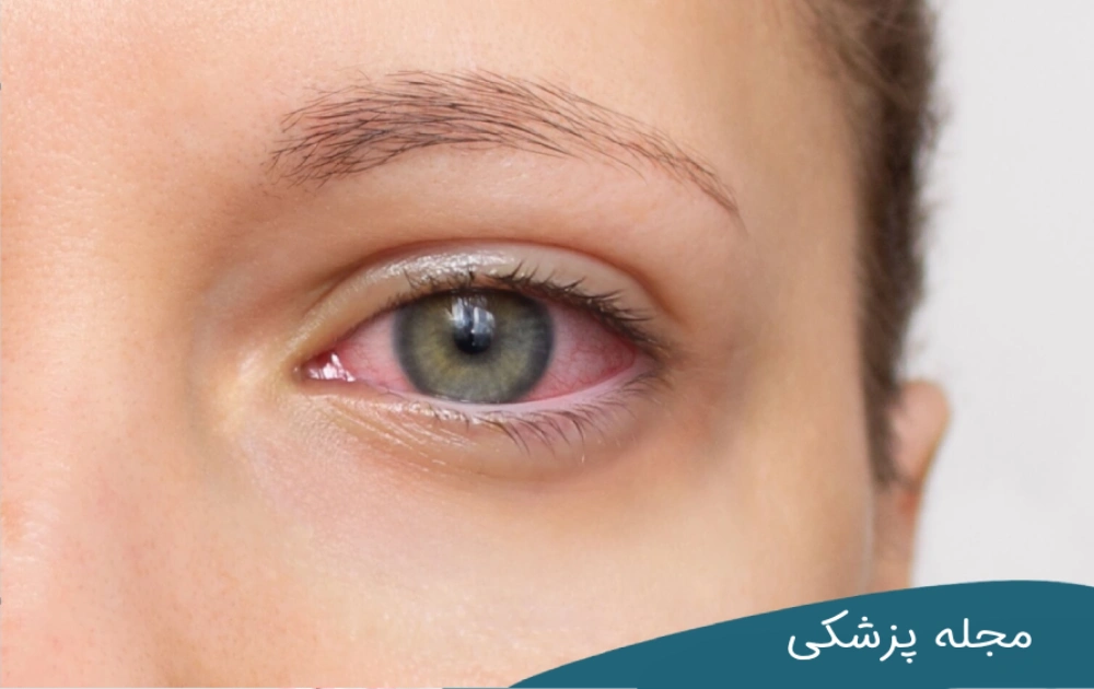 آیا خشکی چشم باعث ضعیف شدن چشم می شود؟ مجله چشم پزشکی خوانساری