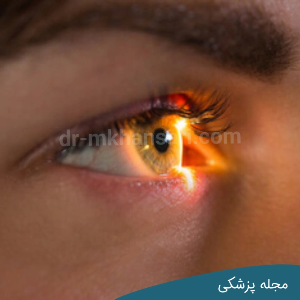 کاندید های مناسب برای عمل لیزیک چشم - مجله پزشکی خوانساری