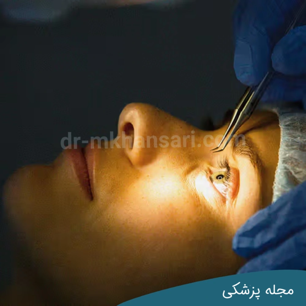 محدودیت تعیین عمل چشم در چند سالگی جهت حذف عینک - مجله پزشکی خوانساری